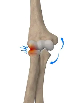Lateral Impingement of the Elbow pic