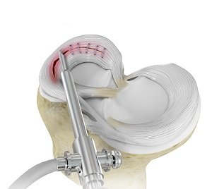 Meniscal Repair Surgery pic