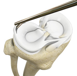 Meniscectomy pic