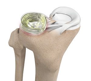 Meniscus Replacement pic