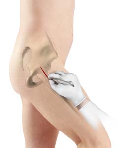 Minimally Invasive Total Hip Replacement pic