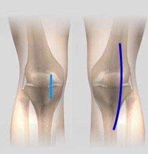 Minimally Invasive Knee Joint Replacement pic
