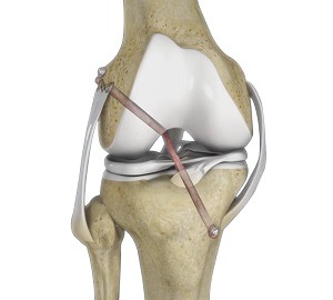 Multiligament Reconstruction of the Knee pic