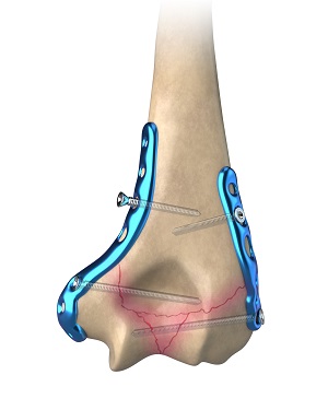 ORIF of the Humerus Fractures pic