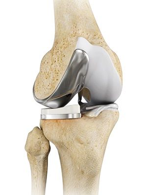 Partial Lateral Knee Replacement pic