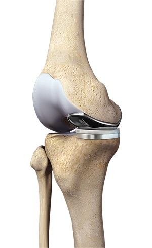 Partial Medial Knee Replacement pic