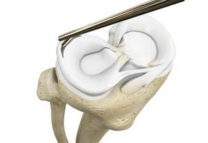 Partial Meniscectomy pic