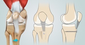 Patella Stabilization pic