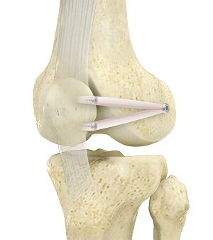 Patellofemoral Stabilization pic