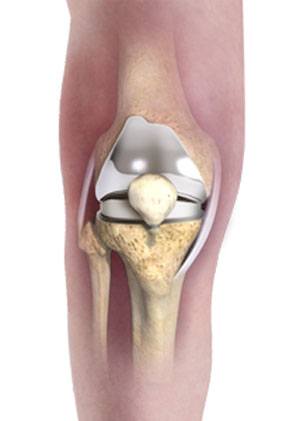 Patient Specific Knee Replacement pic