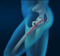 Posterior Hip Replacement pic