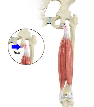 Proximal Hamstring Repair pic