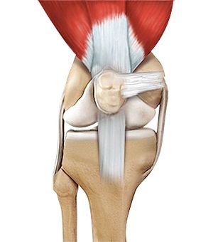 Quadriceps Tendon Repair pic