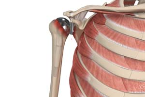 Revision Shoulder Replacement-topic