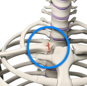 Sternoclavicular Joint (SC joint) Disorders
