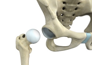 Surgical Dislocation of the Hip pic