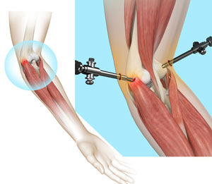 Tennis Elbow Surgery pic