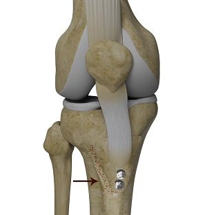 Tibial Tubercle Transfer pic