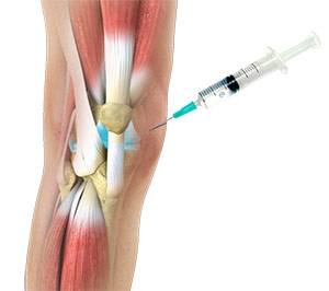 Viscosupplementation pic