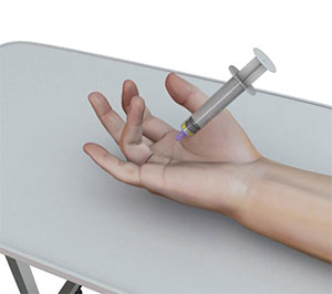 Xiaflex® Treatment in Laguna Woods, Irvine, Fountain Valley, Los Alamitos, Placentia, Yorba Linda pic