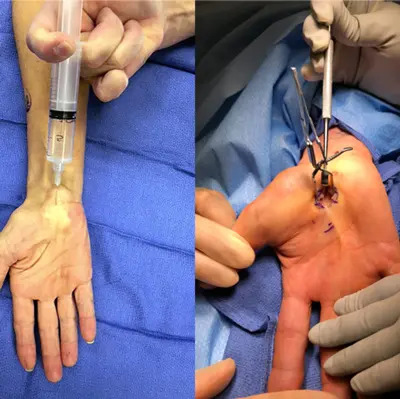 In- Office Surgery/ Wide- Awake Hand Surgery pic