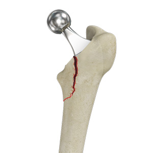 Picture of Femur Fracture