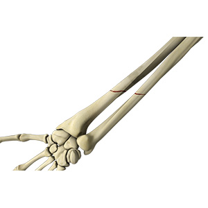 Picture of Forearm Fracture