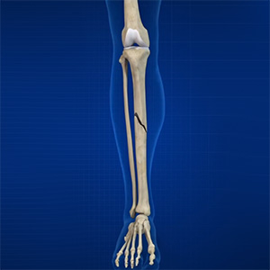 Picture of Fractures of the Tibia
