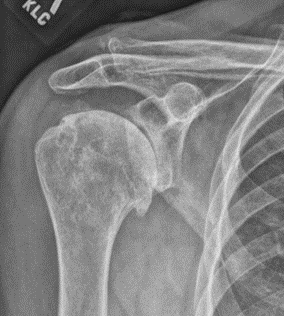 Shoulder Replacement