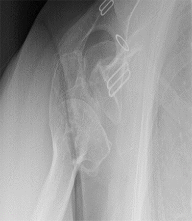 Shoulder Replacement8