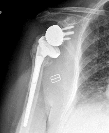 Shoulder Replacement9