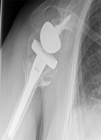 Shoulder Replacement10