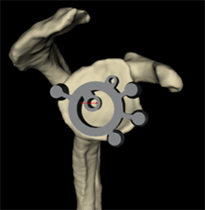 Shoulder Replacement11