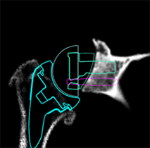 Shoulder Replacement13