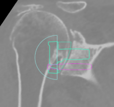 Shoulder Replacement14