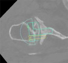 Shoulder Replacement15