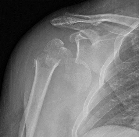 Shoulder Replacement4
