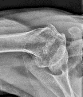 Shoulder Replacement