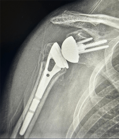 Shoulder Replacement5