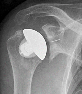 Shoulder Replacement