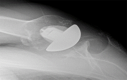 Shoulder Replacement