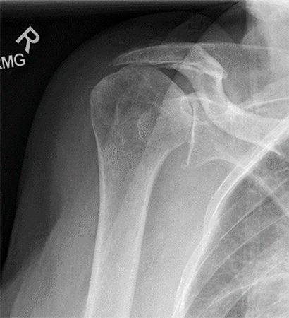 Shoulder Replacement1
