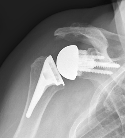 Shoulder Replacement2