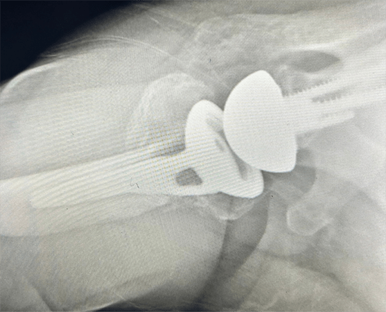 Shoulder Replacement6