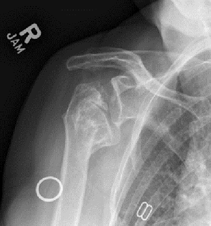Shoulder Replacement7
