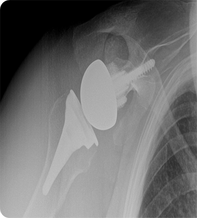Shoulder Replacement3