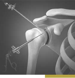 Picture of Arthroscopic Surgery