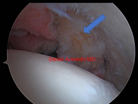 Picture of Reverse shoulder replacement with bone loss