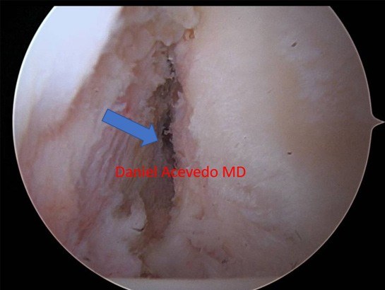 Picture of Arthroscopic view of Left shoulder with glenoid bone loss