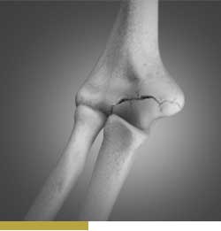 Picture of Elbow Injuries